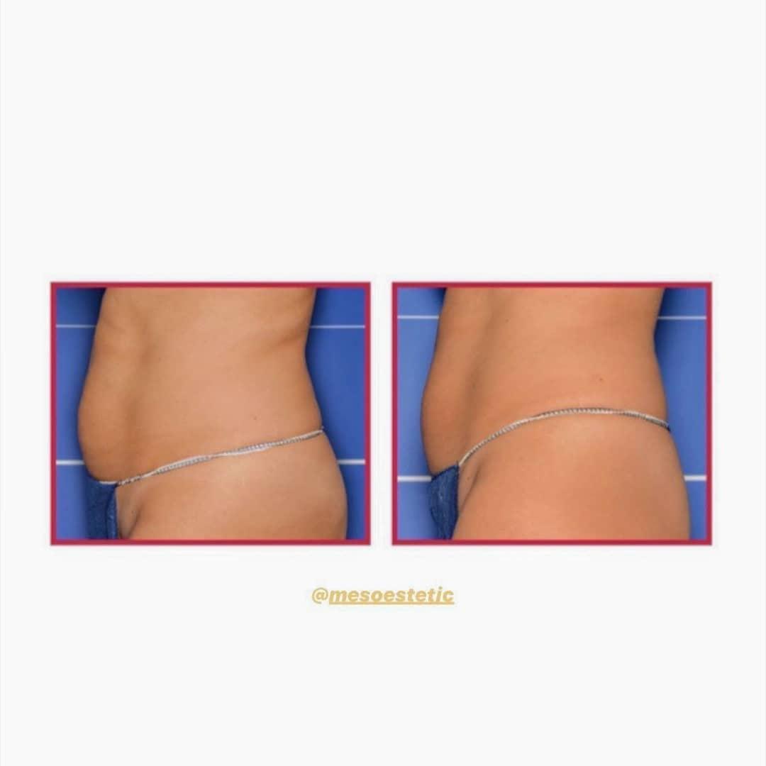 Bodyshock, antes y después de una reducc&mldr;